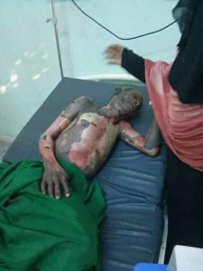 أبين : العجز عن توفير كسرة الخبز يدفع أب لخمسة اطفال لإضرام النار في جسدة .
