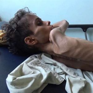 منظمة: سوء التغذية الحادّ أودى بحياة 85 ألف طفل